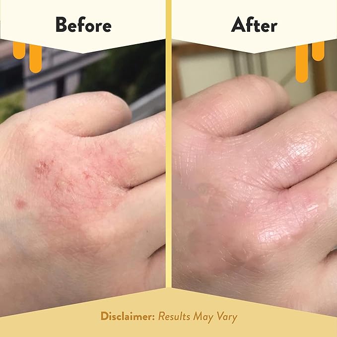 eczema-honey-packshot-04-71gf1ukysll-_ac_sx679.png